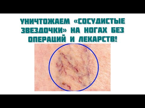 Уничтожаем «СОСУДИСТЫЕ ЗВЕЗДОЧКИ» на ногах без операций и лекарств!