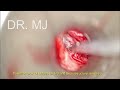 Right Ear Stapedotomy with Fat Sealing of Fenestra