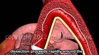 Aortic Dissection - Thoracic & Abdominal - Animation by Cal Shipley, M.D.