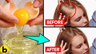20 Best Foods To Fight DHT And Stop Hair Loss