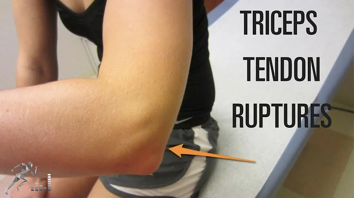 Triceps tendon rupture: Mechanism of injury and treatment