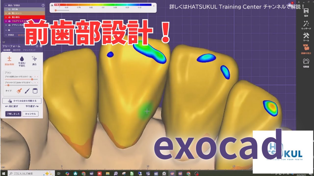 #044　exocad設計　前歯部4本ブリッジ（解説なし版）