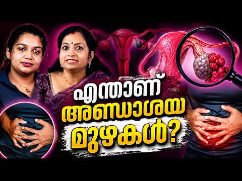 เดเดจเตเดคเดพเดฃเต เด
เดฃเตเดกเดพเดถเดฏ เดฎเตเดดเดเตพ..? What are ovarian tumors..?