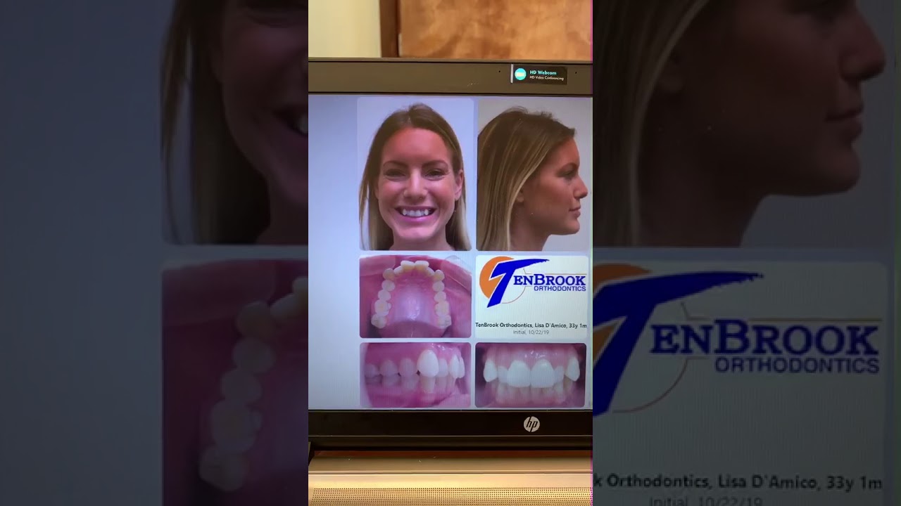 Before and after braces. Adult patient.