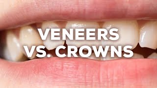 Veneers Vs. Crowns Choosing The Right Smile Solution