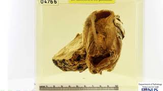 Gallbladder: Carcinoma gross demonstration and local staging