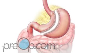 Preop® Laparoscopic Gastric Sleeve Surgery