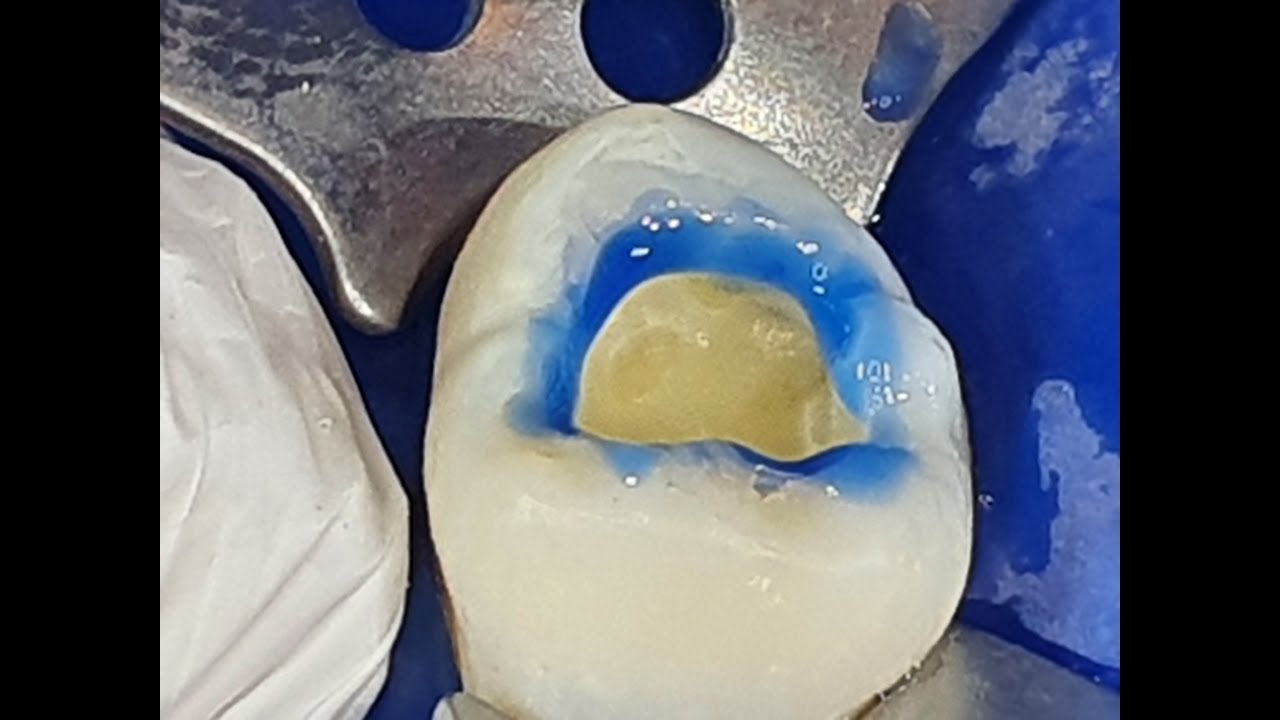 Restauracion clase I