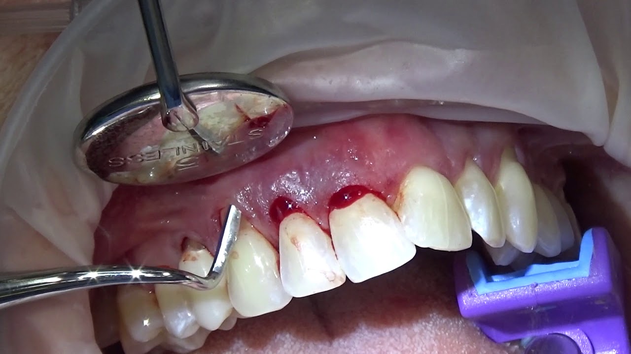 Alloderm Tunnel Graft Preview with Dr Lincoln Harris YouTube