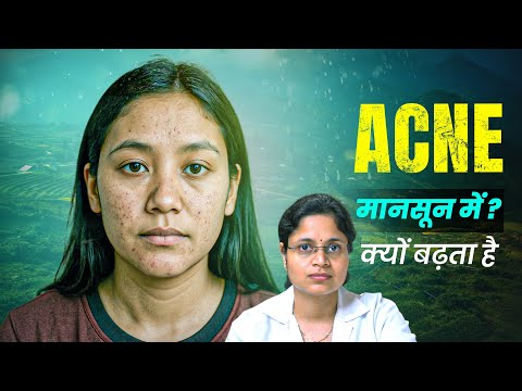 Acne in Monsoon: Why It Increases in Siliguri Weather 🤔 | Hindi