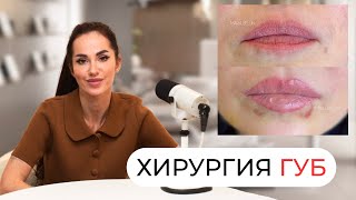 Как НАВСЕГДА увеличить губы без филлеров? Новый тренд: хейлопластика