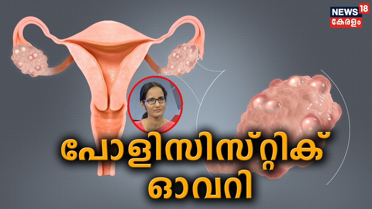 Dr. Q: പോളിസിസ്റ്റിക് ഓവറി | Polycystic Ovary  | 22nd November 2019