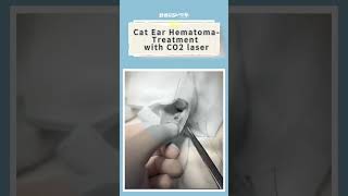 Ear Hematoma Treatment - CO2 laser