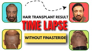 Hair Transplant Results | Time Lapse | Without Finasteride