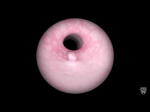 Learn About Endoscopy