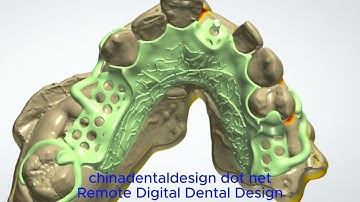 3Shape Dental System Removable Partial Framework Design Chinadentaldesign.net