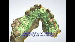 3Shape Dental System Removable Partial Framework Design Chinadentaldesign.net