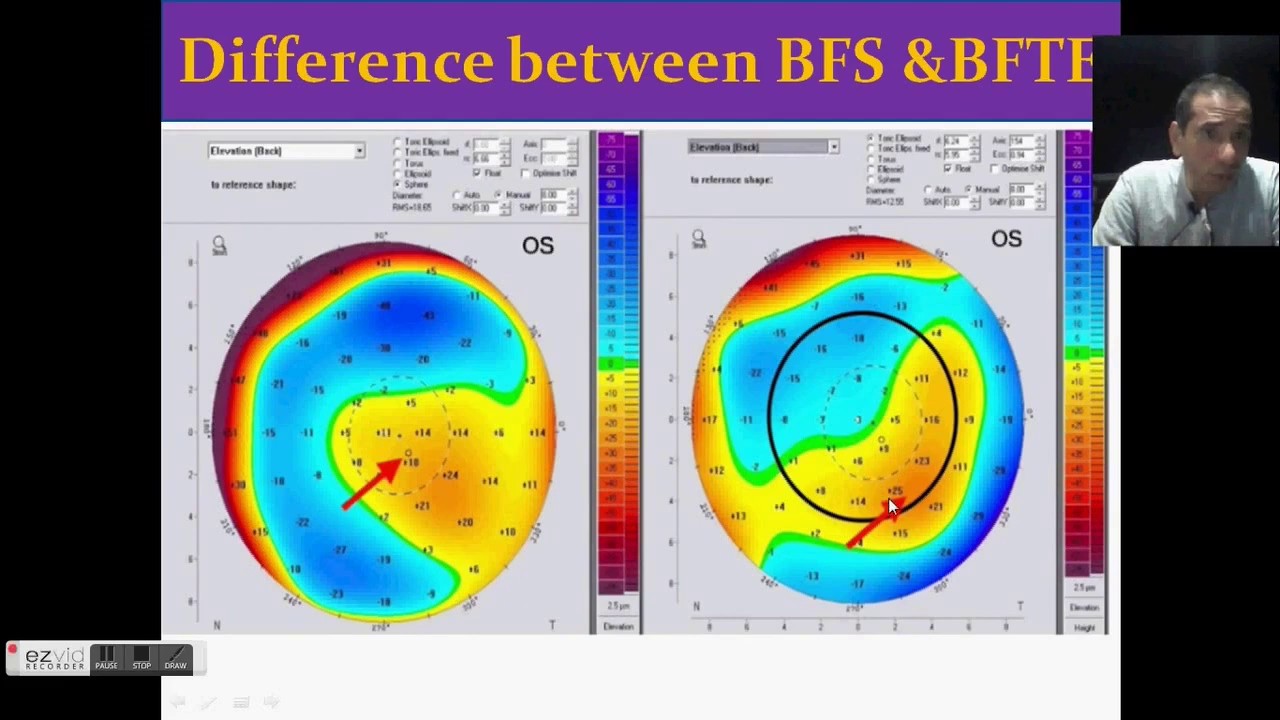 لأطباء العيون: Pentacam.5