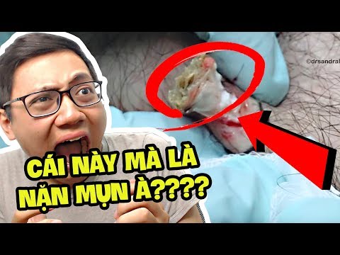 Video CẢNH NẶN MỤN TỞM NHẤT BẠN TỪNG XEM!!! (Sơn Đù Vlog... - youtube