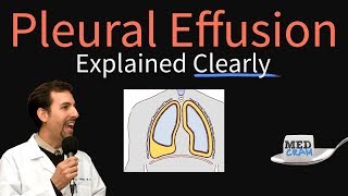 Pleural Effusion Explained Clearly  Causes, Pathophysiology, Symptoms, Treatment,