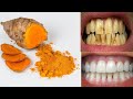 ये जबर्दस्त चीज बस 4 मिनट में गंदे पीले दाँतो को सफेद-चमकदार बना देगी | teeth whitening | dant safed