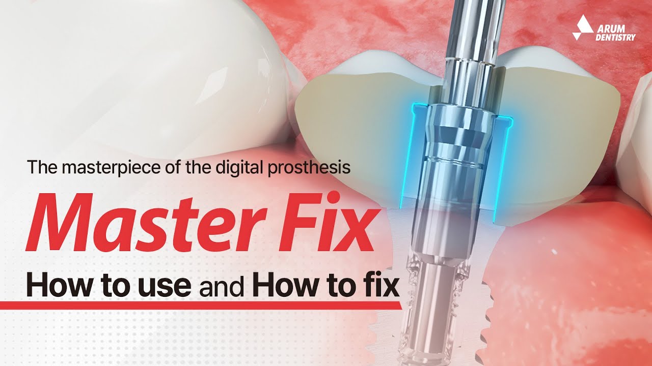 Different fixtures, but one prosthesis!_ARUM Master Fix