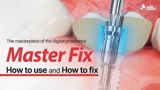 Different Fixtures, But One Prosthesisarum Master Fix