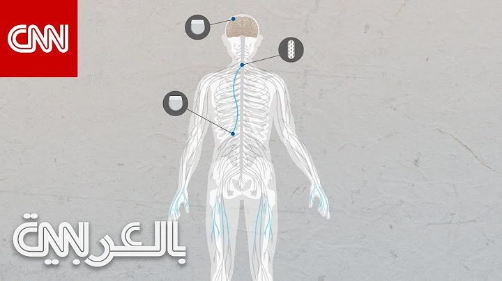 شريحة تستخدم الذكاء الاصطناعي في دماغ رجل مشلول تساعده على استعادة الحركة