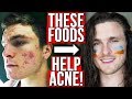 TOP 10 GOOD FOODS FOR ACNE (FROM EXPERIENCE)