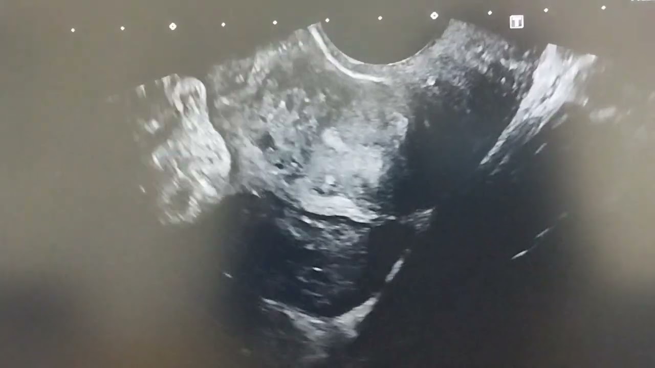 Dermoid cyst
