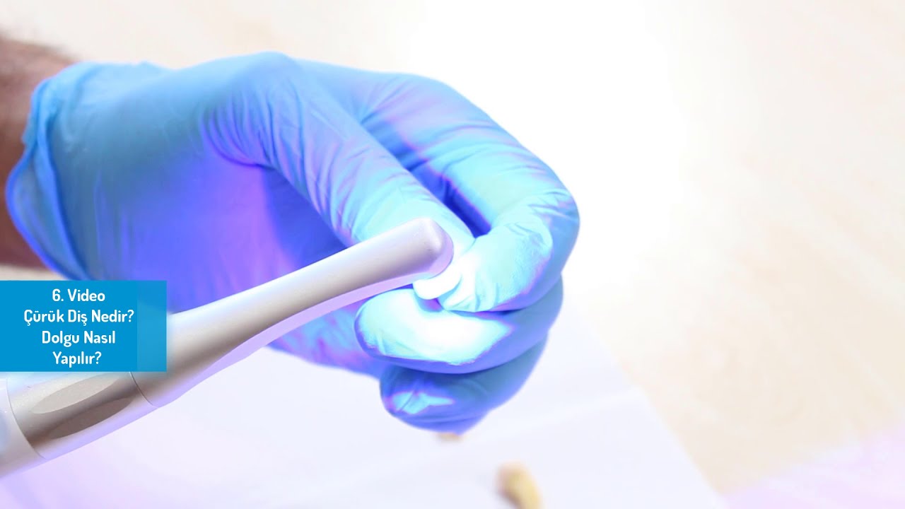 6.Video-Çürük Diş Nedir? Dolgu Nasıl Yapılır?