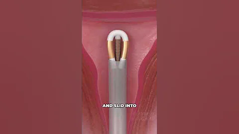 Copper IUD Birth Control (3D Animation)