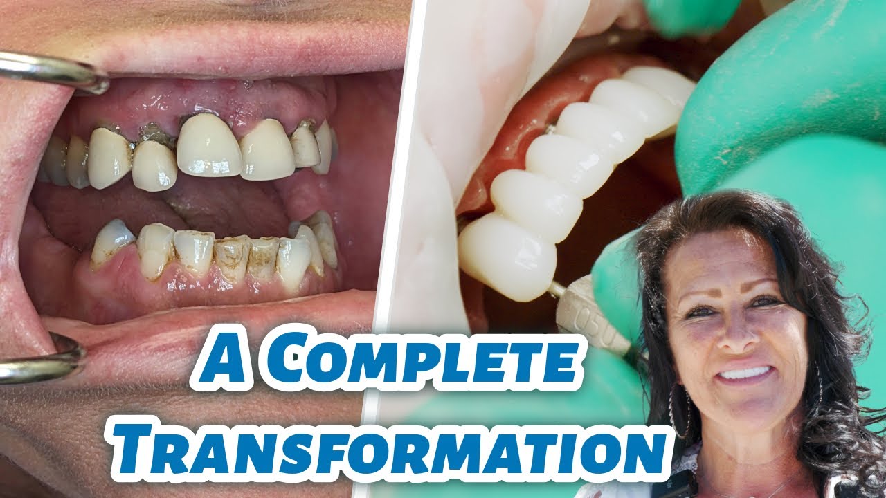 Another Stunning 3 on 6 Smile Transformation