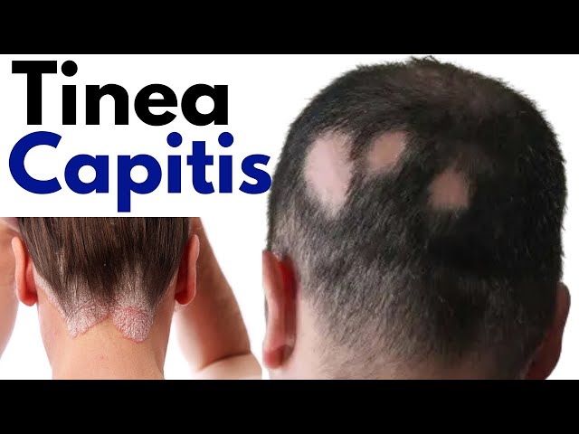 Tinea capitis symptoms treatment, Ringworm of scalp