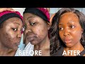 HOW I CLEARED MY ACNE | ACNE JOURNEY