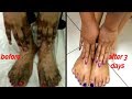 3 Days Guarantee Remove Bleaching Cream Reaction On Hands And Legs At Home