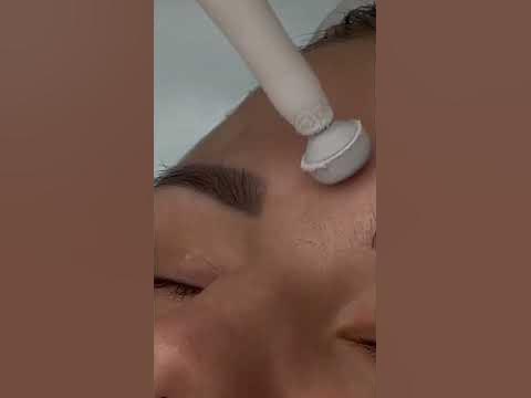 Криотерапия жидким азотом в Loza_clinic #жксавеловскийсити # ...