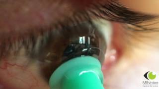 Ventouses pour enlever les lentilles de contact - Lapeyre optique