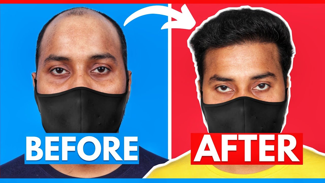Case Study : Aggressive Hairline Hair Transplant Result After 6 Months In High Grade Of Baldness