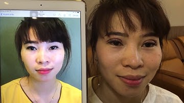 Cắt Mí Mani Open Deep 5D Không Sưng Không Đau Tại Dr.Hải Lê.