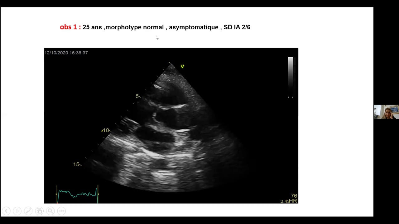 Quantification de la fuite aortique : apport de l’imagerie multi-modalités | S. Fadouach (Marrakech)