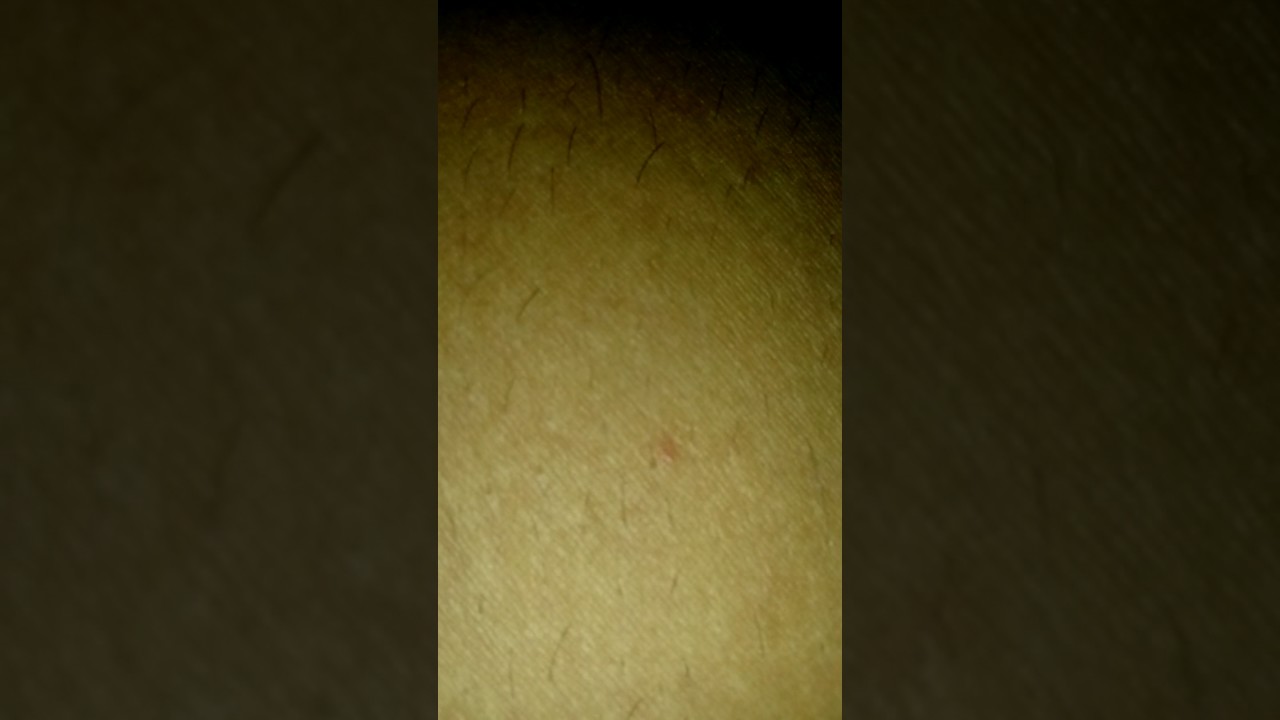 BIGGEST PIMPLE IN THE WORLD - YouTube