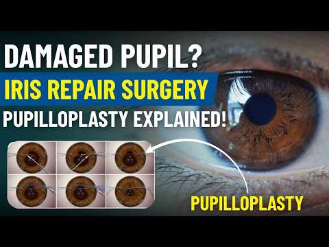 Pupilloplasty Surgery Explained | Repair Damaged Pupil & Restore Clear Vision