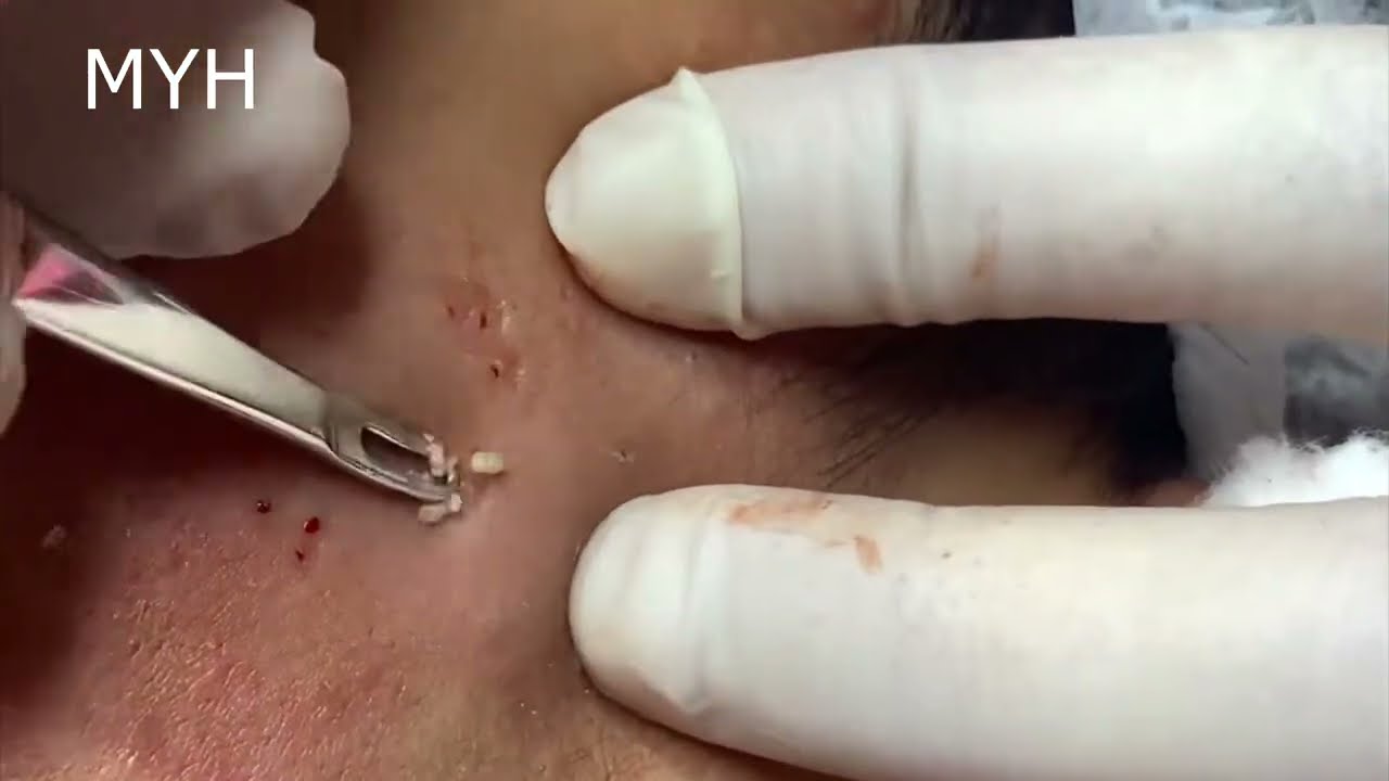 Blackheads Removal New Video EP16