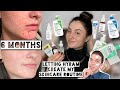 6 MONTH UPDATE/RESULTS: Letting Hyram Create My Skincare Routine | DID IT WORK?