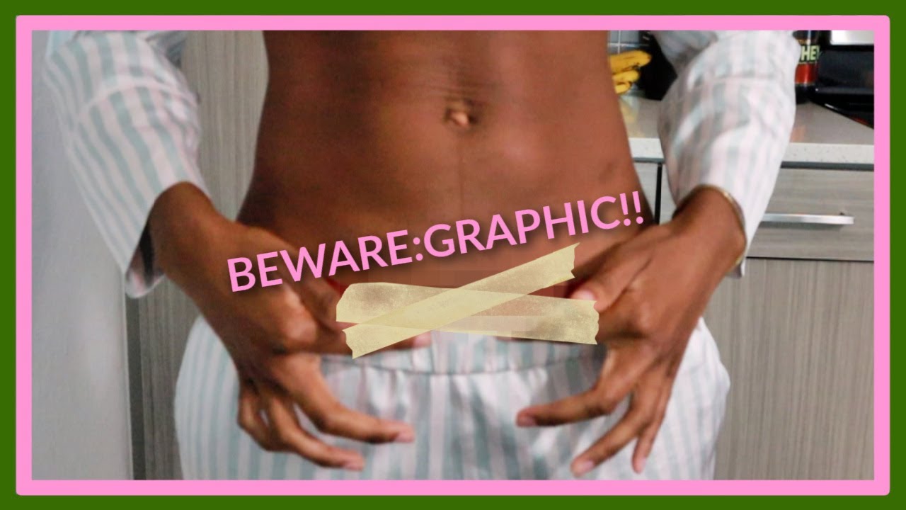 C Section Scar After 1 Year With Pictures Keloid Scar Itching Pain Etc Youtube