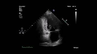 Cardiac Ultrasonogram Showing Apical 2 Chamber View