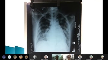 Tim mạch Trình bệnh Viêm cơ tim cấp   BS Tín