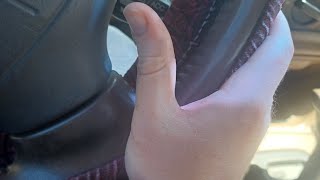 Thumb's uncontrolled muscle twitching caught on camera