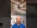 Derm reacts to INSANELY hairy extraction! #dermreacts #doctorreacts #extraction